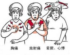 冠心病有哪些癥狀？