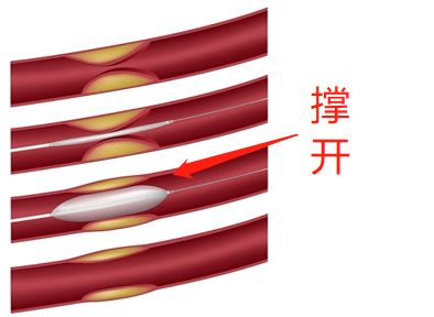 什么是藥物球囊？(圖2)